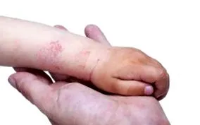 hogyan dermatitis
