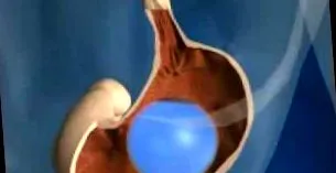 gyomorban