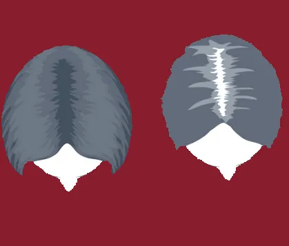fajta hajhullás alopecia