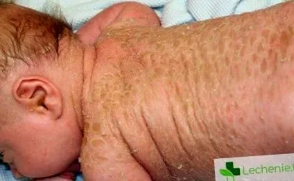 ichthyosis ichthyosis