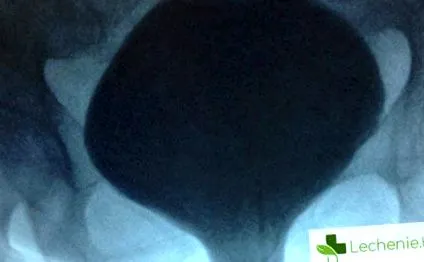 erőlködés köhögés erőlködés köhögés