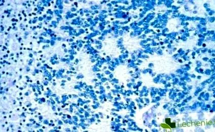 retroperitoneális térben neuroblastoma