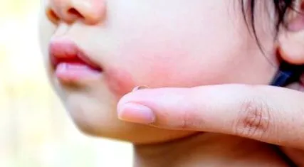 dermatitis