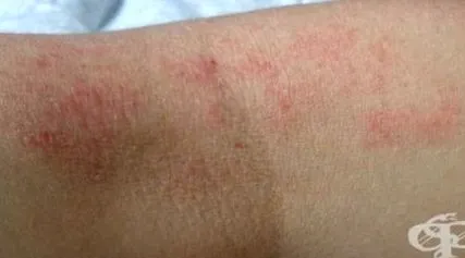 dermatitis dermatitis