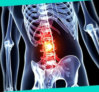 spondylitis bechterew-kór