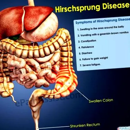 hirschsprung-kór