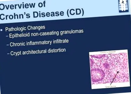crohn-betegség