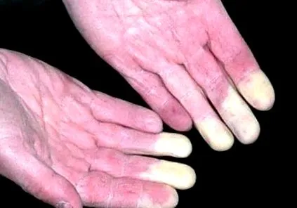 raynaud-kór azonban csak
