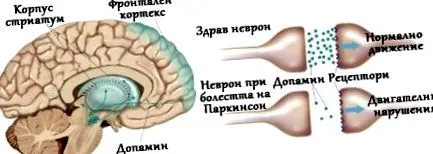 parkinson szenvedő betegeknél