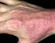 dermatosis tünetei