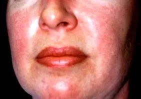 dermatomyositis
