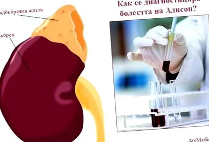 addison-kór elsődleges