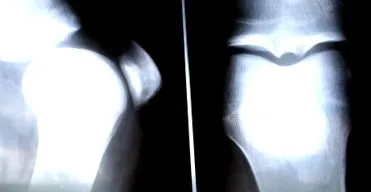 Batmanghelidj által oszteoporózis