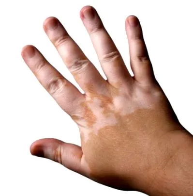 vitiligo otthoni