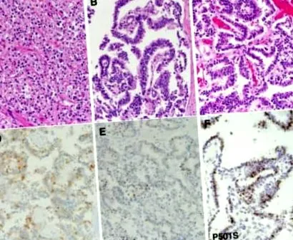 ductalis adenocarcinoma