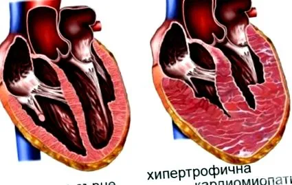 kardiomiopátia