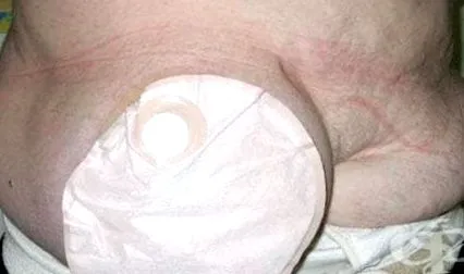 kolosztóma enterostomia