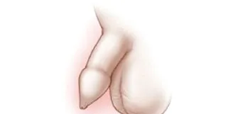 mítosz phimosis