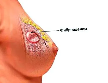jóindulatú fibroadenoma