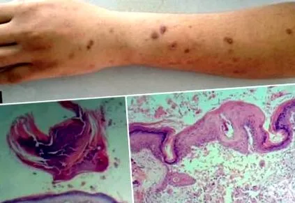 parofollikuláris keratosis