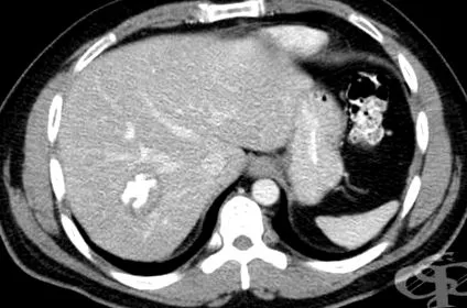 echinococcosis májban echinococcosis májban
