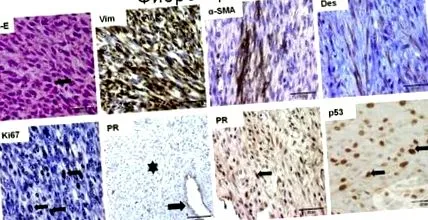 fibrosarcoma