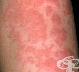 urticaria kolinerg Kolinerg urticaria