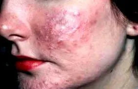 homeopátia