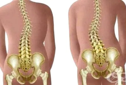 kyphoscoliosisban kyphoscoliosisban