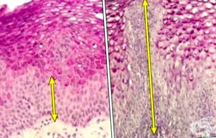 gastroesophagealis reflux