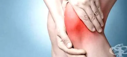 gonartrózis térdízület arthrosis osteoarthritis