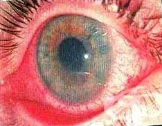 elülső uvea ciliáris test