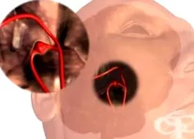néma stroke agyi artéria