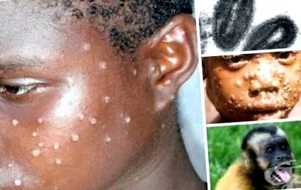 monkeypox által