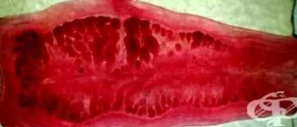 solium