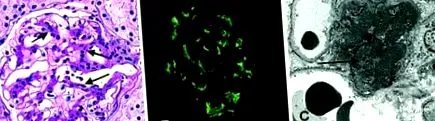 Henoch-Schönlein purpura nephropathia
