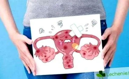 endometriosis endometritis