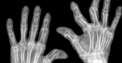 rheumatoid