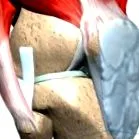ligamentosisának kezelése