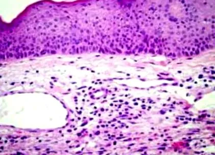 balanoposthitis