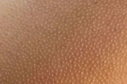 keratosis libabőr