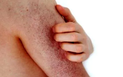 pilaris