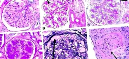 nephropathia nephropathia