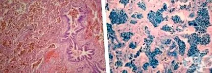 hemosiderosisában Klinikai patológia