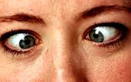 strabismus egyik szem