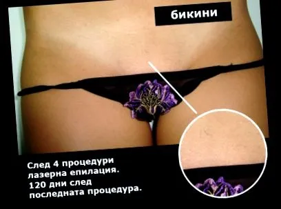lézeres bikini
