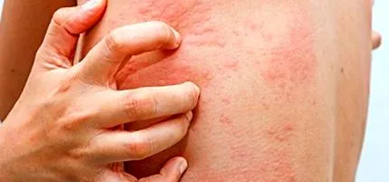 allergiás reakciót egészség
