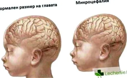 mikrocefália mikrocefália