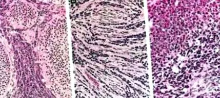 medulloblastoma