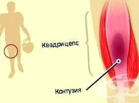 myositis myositis